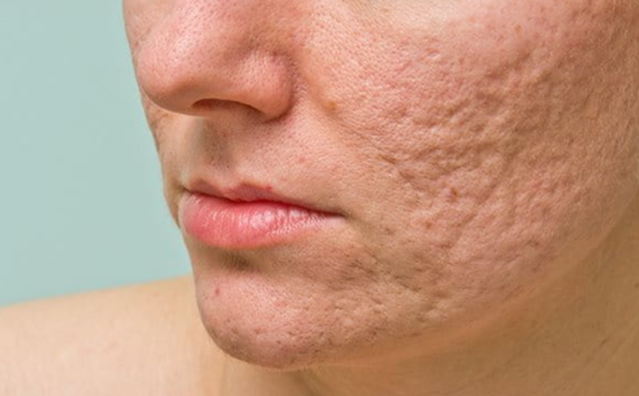 چگونه جای جوش و اسکار را سریع‌تر و مؤثرتر درمان کنیم؟