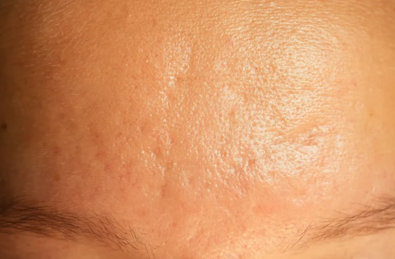 روتین خانگی برای کاهش ظاهر منافذ باز پوست