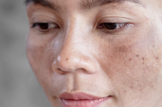 درمان لک‌های بارداری؛ راهکارهای ایمن کلینیکی و تخصصی