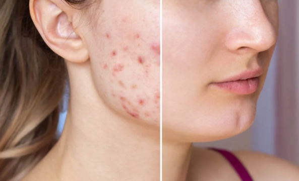 درمان قطعی جوش صورت؛ از علت‌ها تا مراقبت‌های روزانه