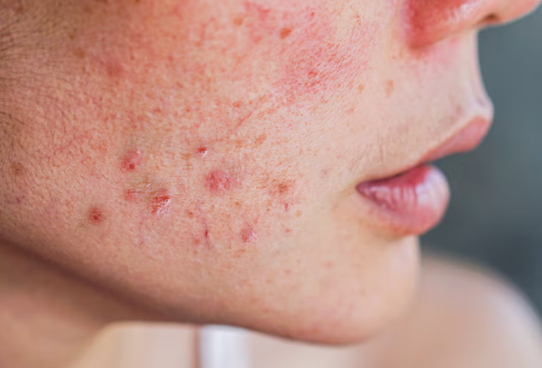 روش‌های کلینیکی برای درمان اسکار جوش