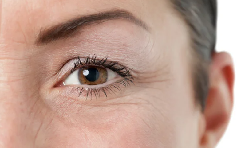 درمان چروک دور چشم؛ از کرم مناسب تا روش‌های تخصصی